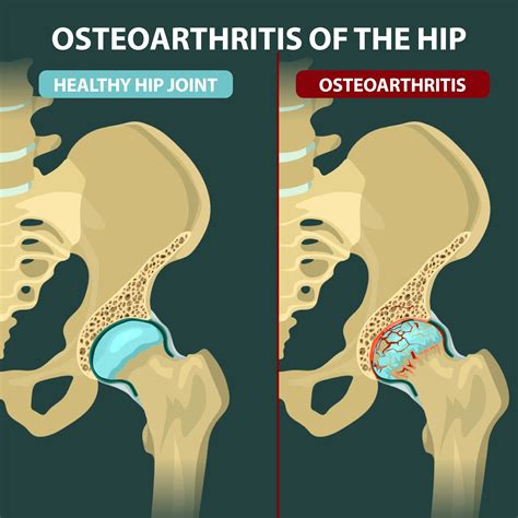 arthritis in back hips and knees